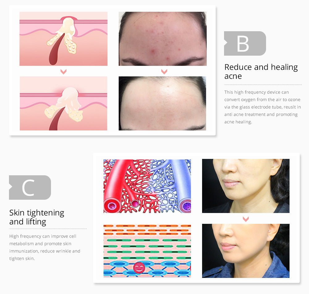 Shape Tactics Portable High-Frequency Facial & Scalp Therapy System