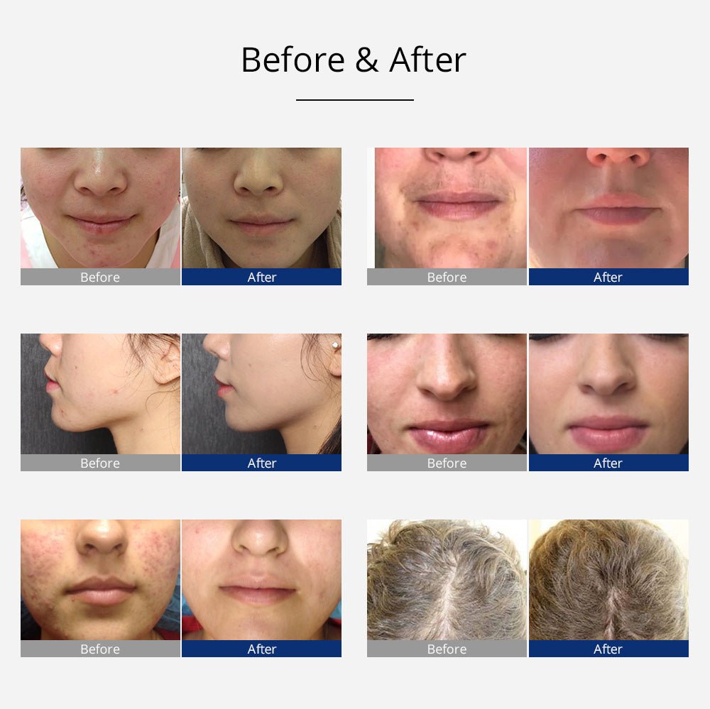 Shape Tactics Portable High-Frequency Facial & Scalp Therapy System