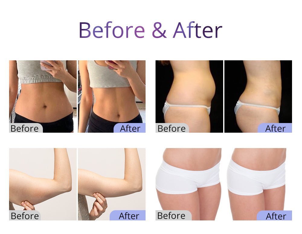 Shape Tactics UltraShape 2.5 Cavitation System